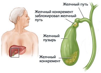 Холецистектомія - це операція з видалення жовчного міхура