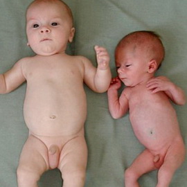 Дистрофія - це порушення травлення грудничка, що характеризується патологічно низькою масою тіла