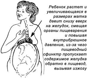 Жінку під час вагітності   може замучити не тільки блювота, але і відрижка з печією через тиск, що чиниться збільшеною маткою на травні органи