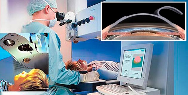 ;   кератоконус - офтальмологічна патологія, при якій рогова оболонка ока, в зв'язку з тонкою, приймає форму конуса;   регулярне вживання лікарських препаратів, наприклад, кортікостероїдной групи, одним з побічних дій яких є негативний вплив на зорові органи;   відшарування сітківки ока, непрооперованих своєчасно;   активно розвивається катаракта, яка б знизила гостроту зору;   товщина рогівки становить менше, ніж 400-450 мікромілліметров;   наявність тільки одного ока