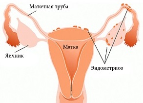 Це захворювання, що виникають в результаті патологічного (ненормального) розростання ендометріоїдних клітин слизової оболонки матки