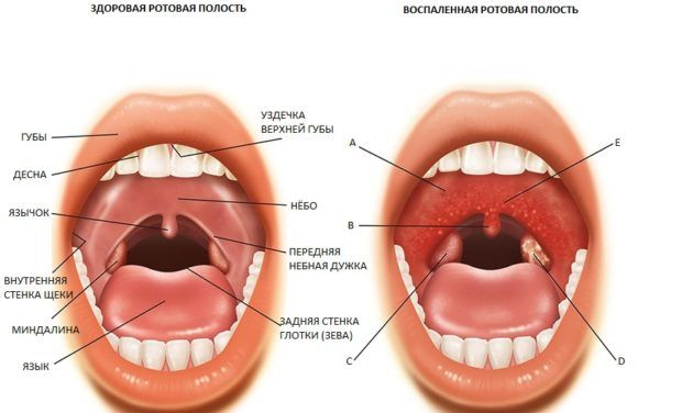 є постійний запальний процес у ротовій порожнині або дихальних шляхах (найчастіше це карієс, фронтит, гайморит);   викривлена ​​носова перегородка;   ослаблений імунітет;   розрослися аденоїди
