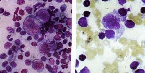 В-клітинна;   Т-клітинна;   дифузна В-крупноклеточная;   фолікулярна