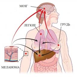 Меланома характерна швидким і раннім метастазуванням