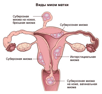 Прийнято виділяти по розміщенню вузлів в матці - підслизову або субмукозную (проростання у внутрішньому шарі матки), ітрамуральную (в товщі матки) - при цій формі вузол може мати ніжку і доходити до шийки матки і навіть за її межі (народжується вузол), субсерозну або подбрюшінно (зростання в зовнішній шар матки) форми міоми