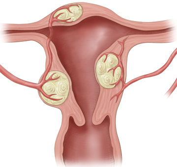 Коли плацента знаходиться в області міоматозного вузла відбувається наступні: змінюється анатомія матково - плацентарних судин, а це призводить до дрібних крововиливів в них і в подальшому до плацентарної дисфункції, що відбивається на майбутньому малюку у вигляді кисневої недостатності, нестачі поживних речовин і відставанні в розвитку
