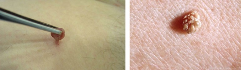 Ступні постійно знаходяться в дискомфорті, шкіра натирається, потіє, що стає причиною наростів