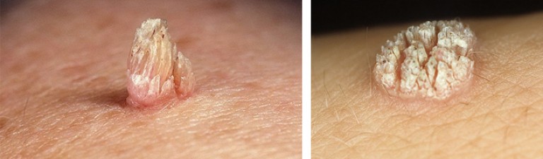 Якщо у людини поганий імунітет, він любить ходити босоніж, то у нього більше ймовірності заразитися вірусом папіломи