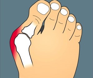 Щоб визначитися, до якої міри відбулося деформування суглобів на великому пальці, необхідно спробувати відтягнути його від середнього пальця ноги, як це зазначено на фото