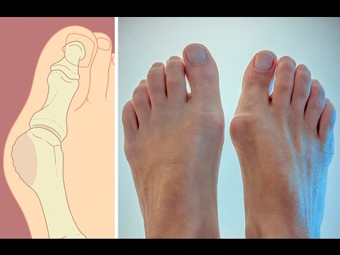 Тільки тоді шишки між пальцями і на них зникнуть назавжди