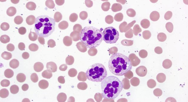 аномалії нейтрофілів