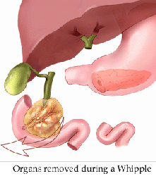 При раку підшлункової після того, як пацієнт проходить такі тести, як УЗД, КТ, ендоскопічні дослідження, які інформують лікаря про розмір, стан пухлини, він встановлює можливість резекції злоякісного утворення