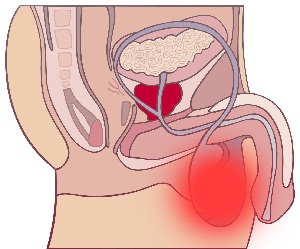 Орхит - серйозне захворювання чоловічих сечостатевих органів, яке характеризується запальними процесами одного або обох яєчок