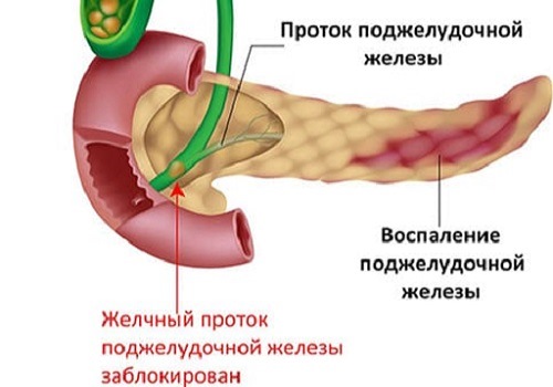 1 - хронічне запалення без додаткових уточнень