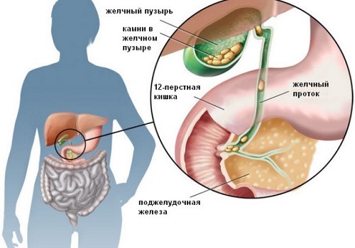 Хвороба найчастіше стає вторинним ураженням в результаті каменів в жовчному міхурі, тривалого вживання ліків, недотримання дієти, алкоголізму