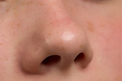 Прищі біля носа можуть бути проявом не тільки вугрової хвороби, а й різних дерматитів (алергічного, контактного, периорального або себорейного)