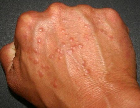 Підшкірні прищі на руках з'являються при надмірній активності сальних залоз