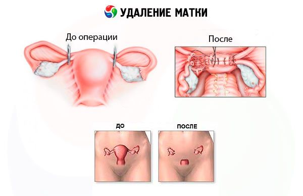 Дефіцит жіночих статевих гормонів позначається на роботі серцево-судинної системи, зростає ризик атеросклерозу, інфактов, інсульту