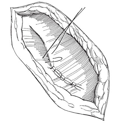 Тепер розглянемо, які види швів існують: