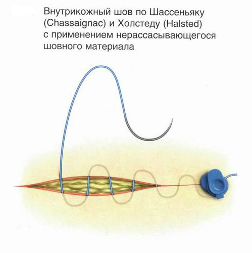 Однією з різновидів зовнішніх швів є косметичний шов