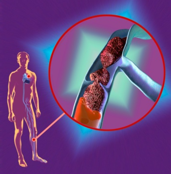 Тромбоз - вид судинної патології, при якому відбувається місцеве утворення згустка крові (тромбу) в посудині