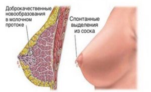 Якщо жінка помітила виділення прозорої, зеленуватого або бурого рідини, це може свідчити про виникнення внутрипротоковой папіломи