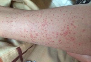 Часто почервоніння виникає нижче колін