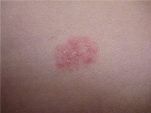 Основним ускладненням червоних точок при цукровому діабеті є гангрена