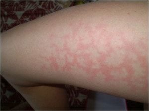 При истончении судинних стінок і їх ураженні з'являються червоні крапочки на литках і попереду кінцівок