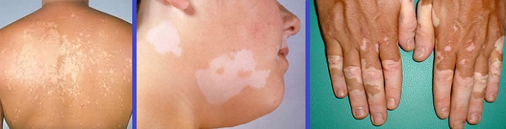 Вітіліго - це стан, що характеризується втратою шкірного пігменту меланіну, який виробляється особливими клітинами - меланоцитами