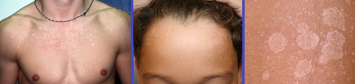 Це ще одна з найпоширеніших і фізично нешкідливих причин появи білих плям на шкірі