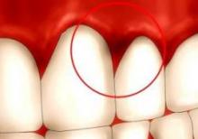 Першою ознакою запалення є почервоніння м'яких тканин і кровоточивість, яка може спостерігатися при чищенні зубів і прийомі їжі