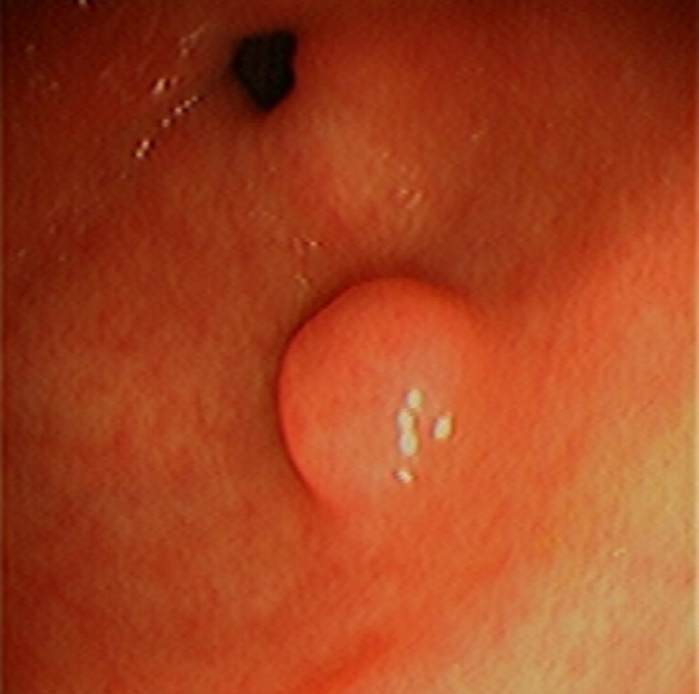 Оптимальним варіантом точного діагностування є ендоскопічне обстеження
