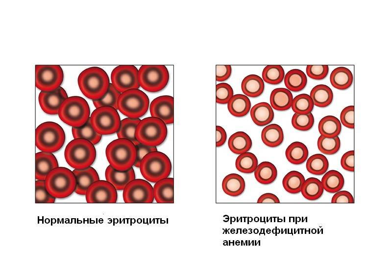 Анемія - це стан, при якому знижується кількість гемоглобіну та еритроцитів у крові