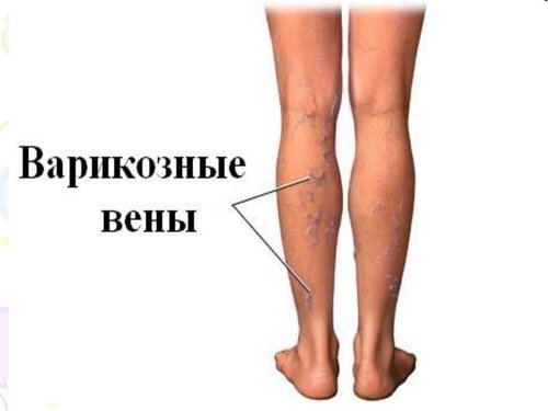 Традиційно при перших ознаках варикозу застосовують гелі на основі гепарину або троксерутину