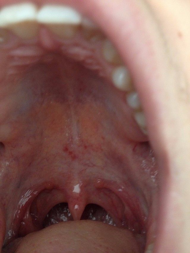 Що значить цей симптом, як його лікувати і чи потрібно йти до педіатра