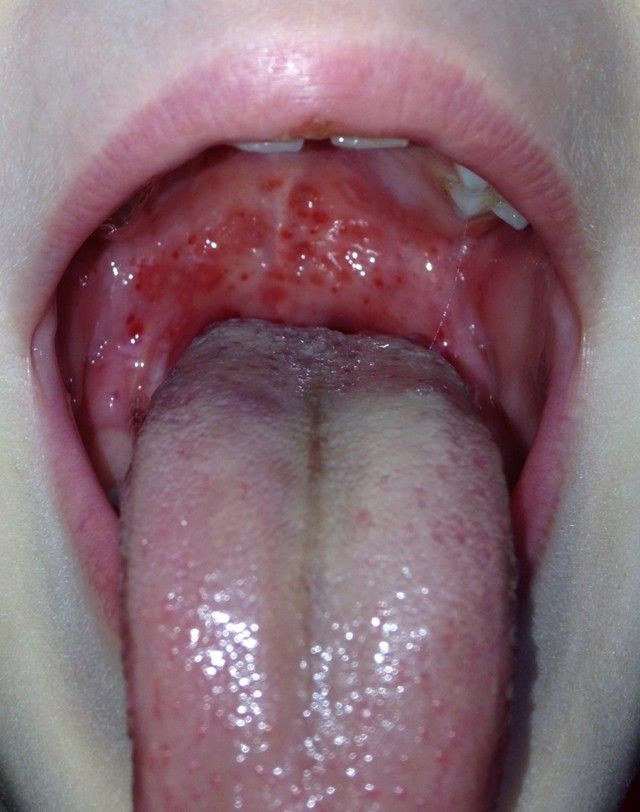 Висип, раптово з'явилася в роті дитини і небі, може бути проявом алергічної реакцією на який-небудь продукт харчування