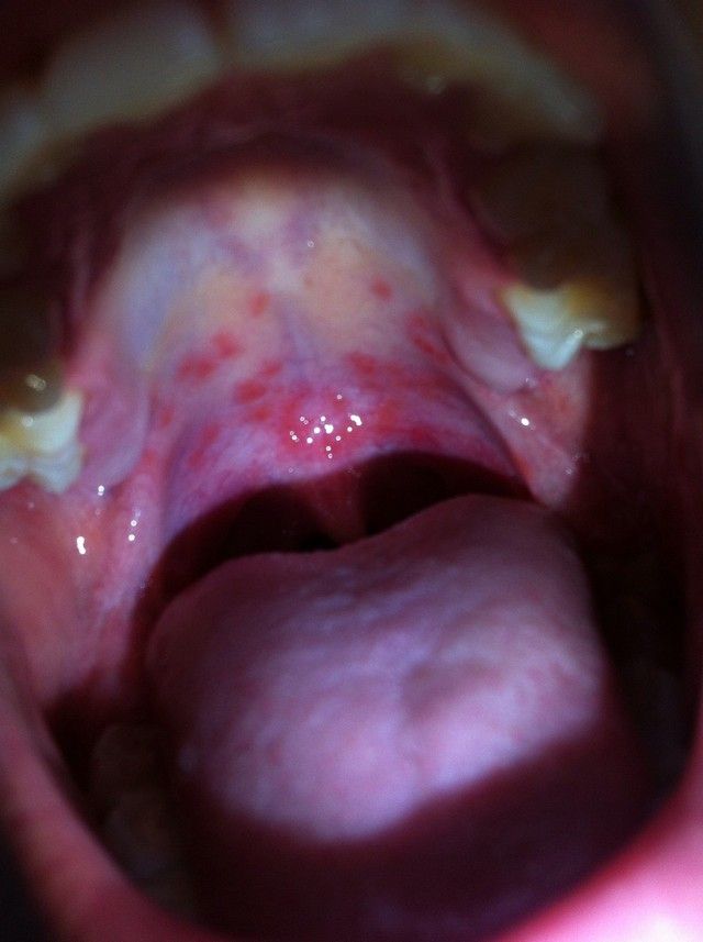 При стрептококової природі червоної висипки спостерігаються такі симптоми: