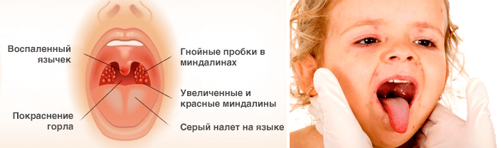 герпесная ангіна