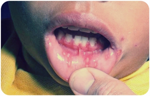 відчуття сухості в роті; в горлі відчувається кому; сухий кашель в ранковий час і ночами; болю в голові, м'язах; неприємні відчуття при ковтанні