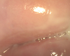 Лікування ерозії шийки матки: пацієнт П