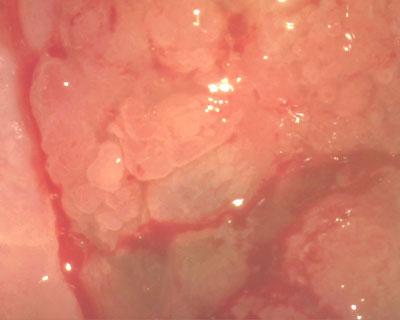 Механізм виникнення придбаної ерозії полягає в тому, що відбувається переміщення слизової оболонки цервікального каналу (одношарового, погано виконуючого механічні захисні властивості епітелію) на поверхню (вагінальну частину) шийки матки