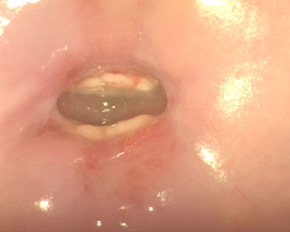 Лікування ерозії шийки матки: пацієнт А