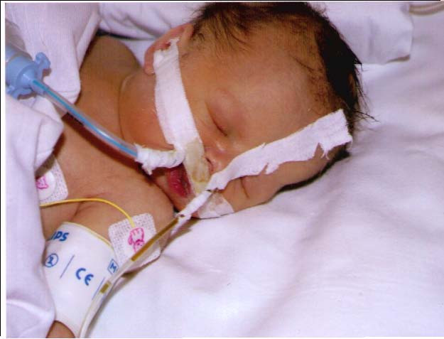 Після повторної операції мій стан погіршився, чутливість в ногах пропала повністю