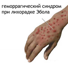 У вагітних жінок в цю стадію перебігу геморагічної лихоманки настає викидень