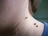 Папіломи є доброякісні новоутворення, які виникають не тільки на шкірі, але і на слизових всередині організму