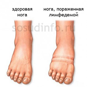 Чи не дивлячись на те, що лімфостаз має прогноз цілком сприятливий, якість життя при цьому захворюванні порушується істотно