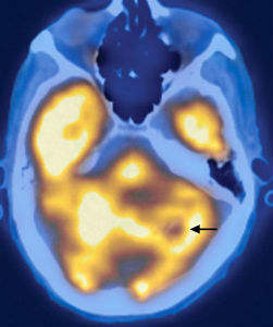 Метастази в голові - це ракові утворення, які виникли в результаті первинного ураження іншого органу