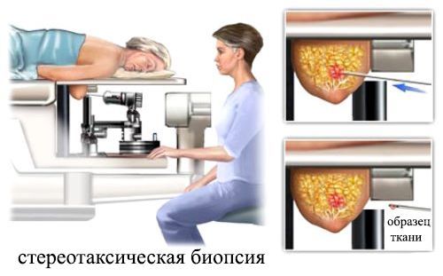 Якщо ж пухлина доброякісна, то судин в ній буде небагато