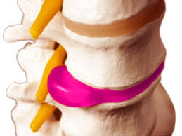 Грижа міжхребцевого диска - одне з найскладніших захворювань хребта і нервової системи, яке супроводжується деформацією міжхребцевого диска, зміщенням його за межі нормального положення і можливим розривом фіброзного кільця